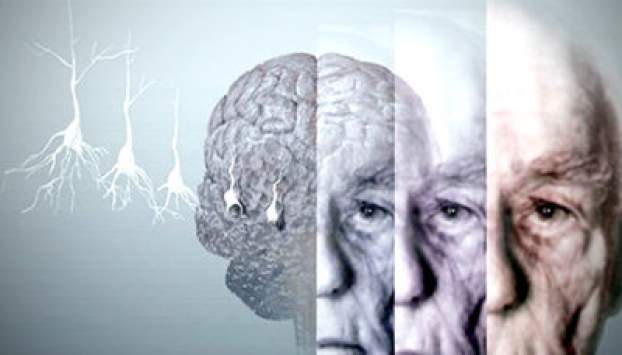 Alzheimer kór