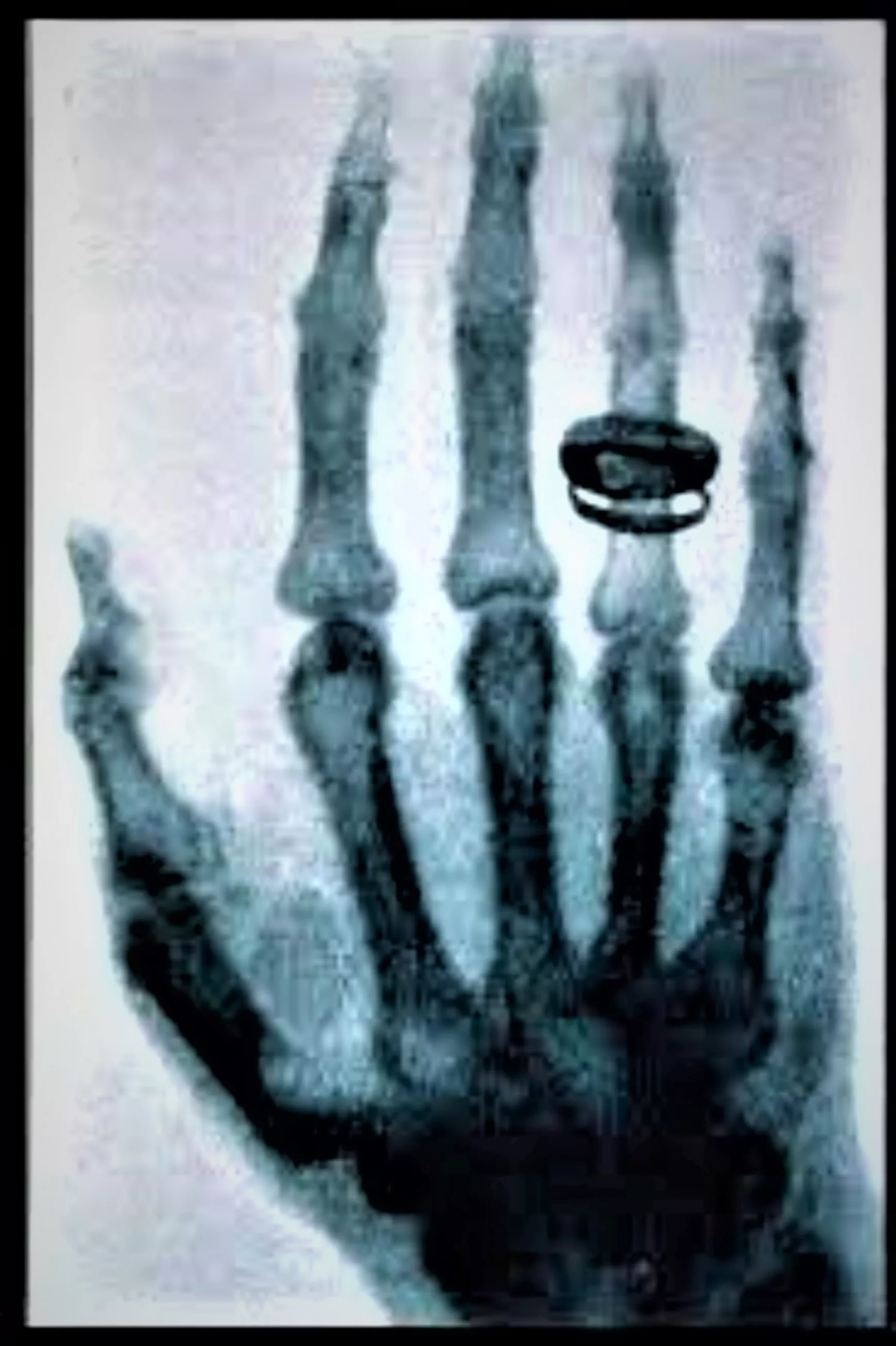 Az illető javasolta a röntgensugarak elnevezést