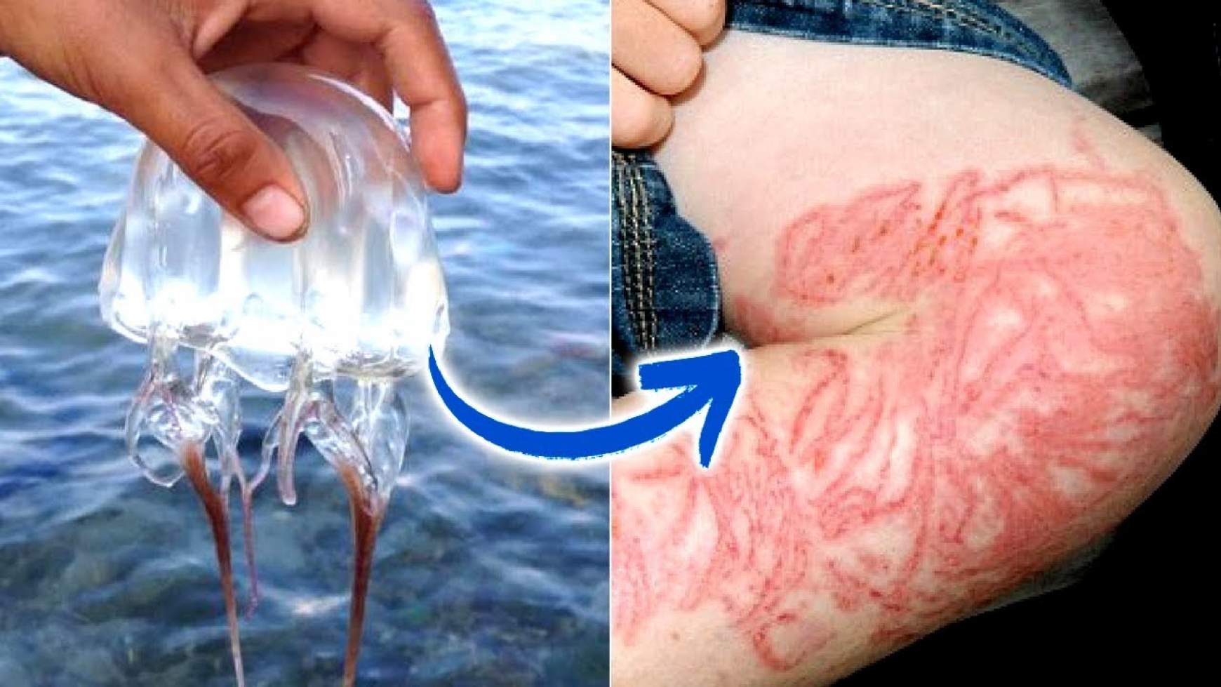A medúzacsípés következményei