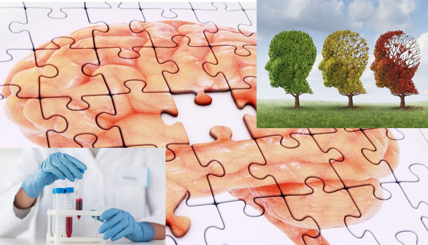 alzheimer-diagnosztika.jpg alzheimer-diagnosztika.jpg
